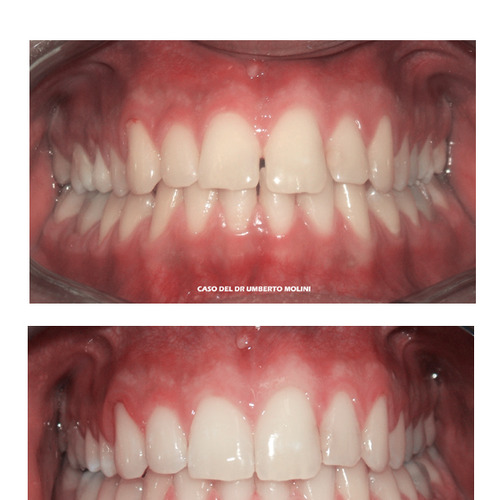 Protrusione e spazi tra denti 