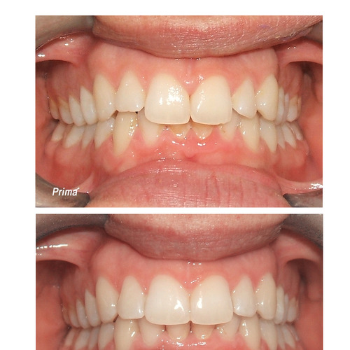 Denti riallineati con Invisalign