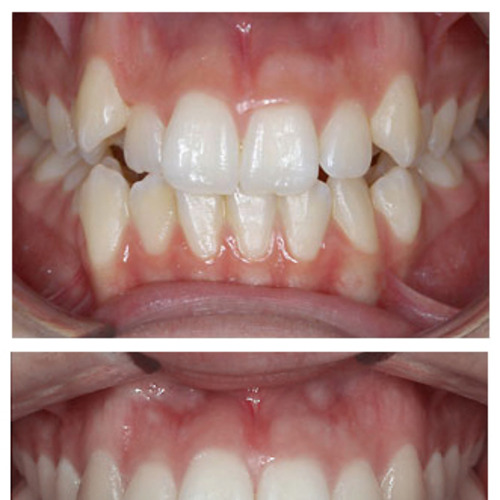 Foto - prima e dopo -  denti allineati con Invisal