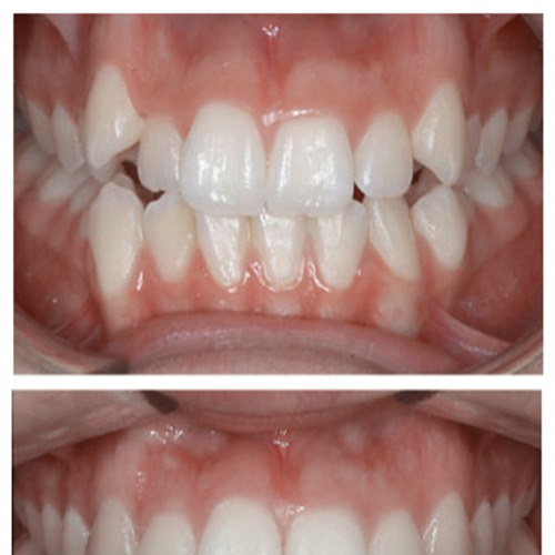 Ortodonzia Invisalign